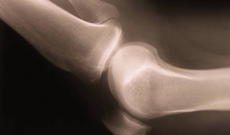 New Study Questions the Benefits of Knee Surgery